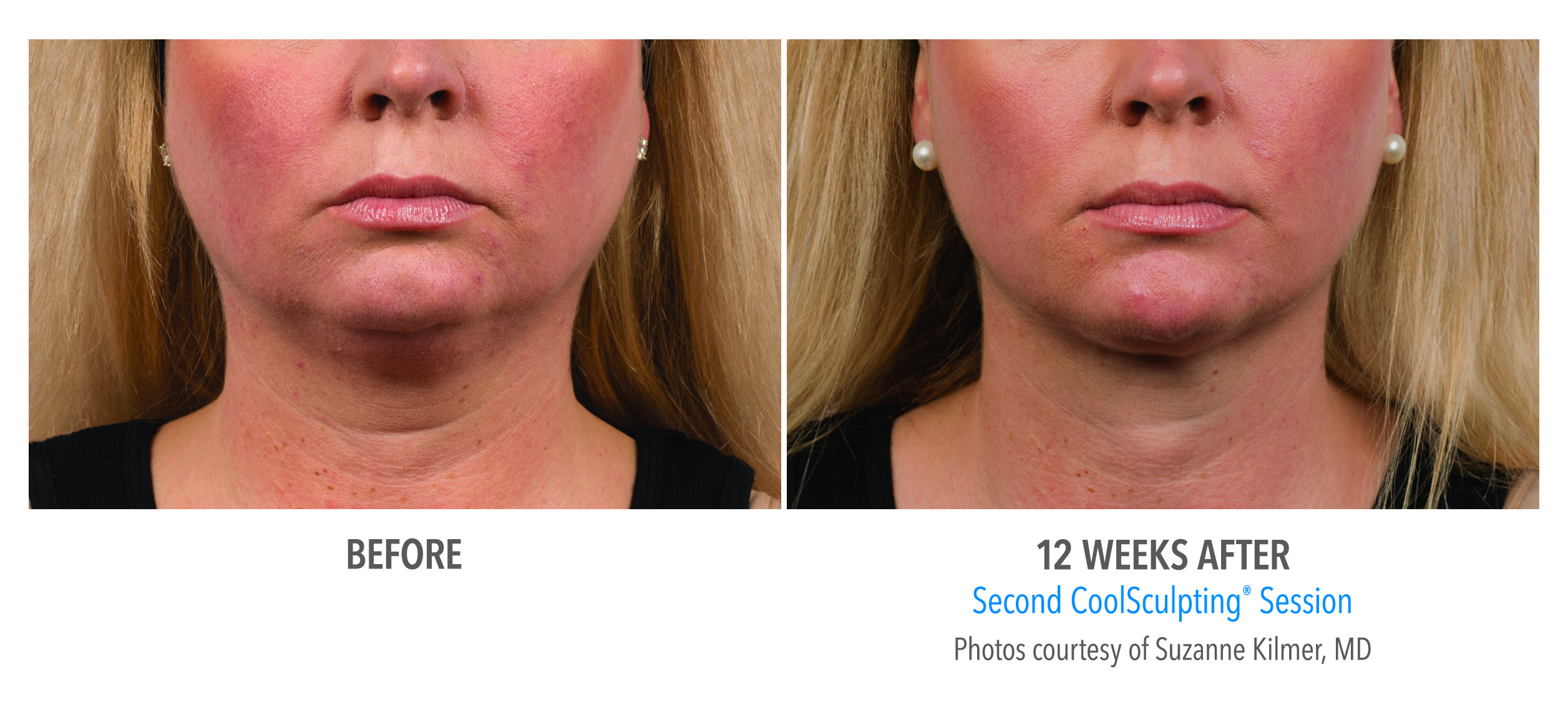 Coolsculpting Before and After