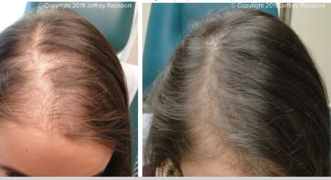 How Does PRP Hair Restoration Work? - Elan Skin and Laser