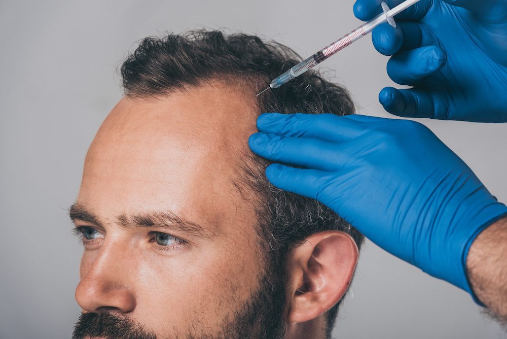 How Does PRP Hair Restoration Work?