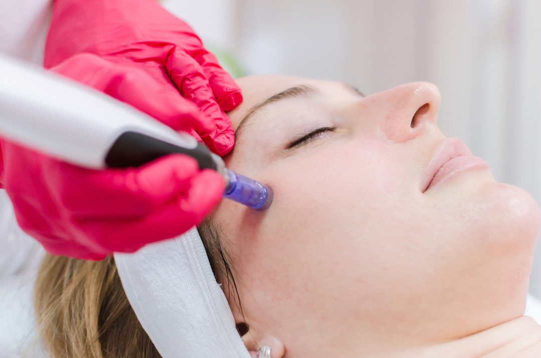 MicroneedlingOpt
