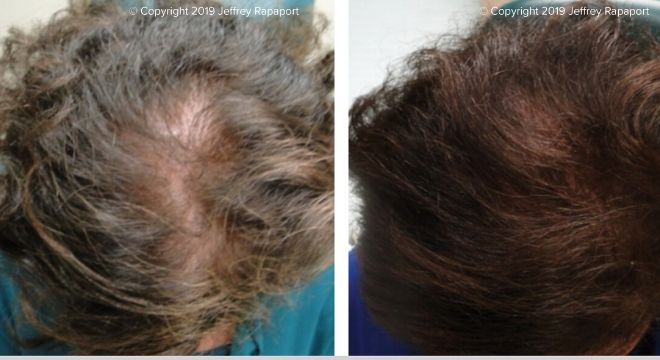 PRP-Secondary Image 1