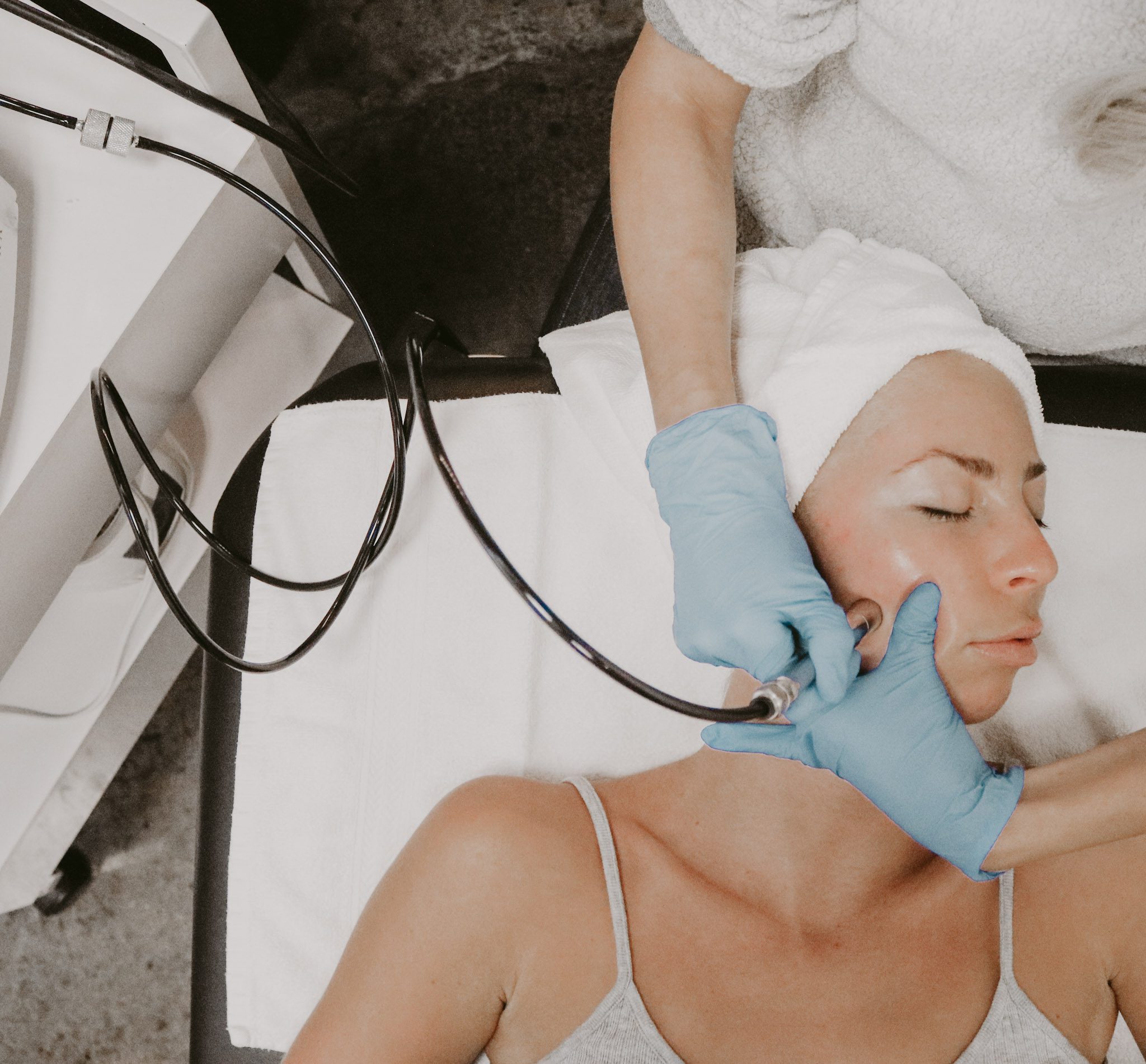 microderm.2 Coolsculpting Before and After