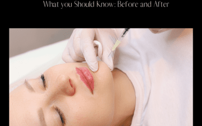 Kybella Injections: What You Should Know Before & After