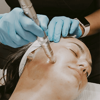 Microneedling
