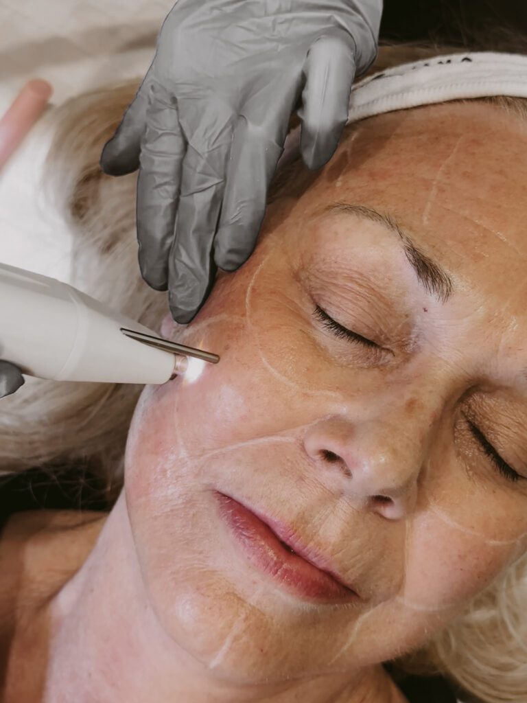 pure_plasma_4 Coolsculpting Before and After