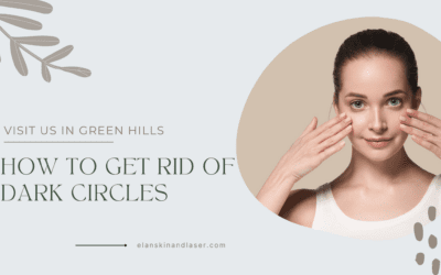 How to Get Rid of Dark Circles and Puffy Eyes