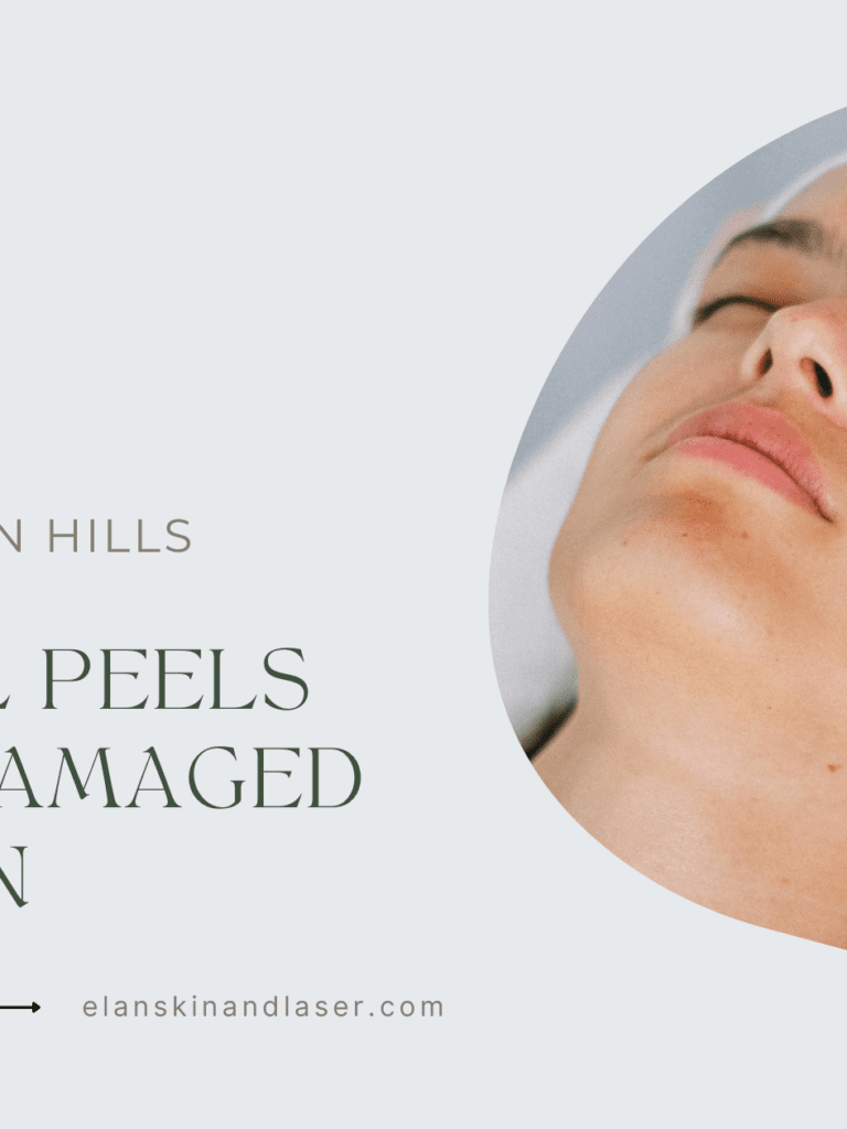 Chemical Peels for Sun-Damaged Skin: Undoing the Effects of UV Exposure