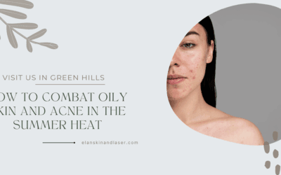 How to Combat Oily Skin and Acne in the Summer Heat