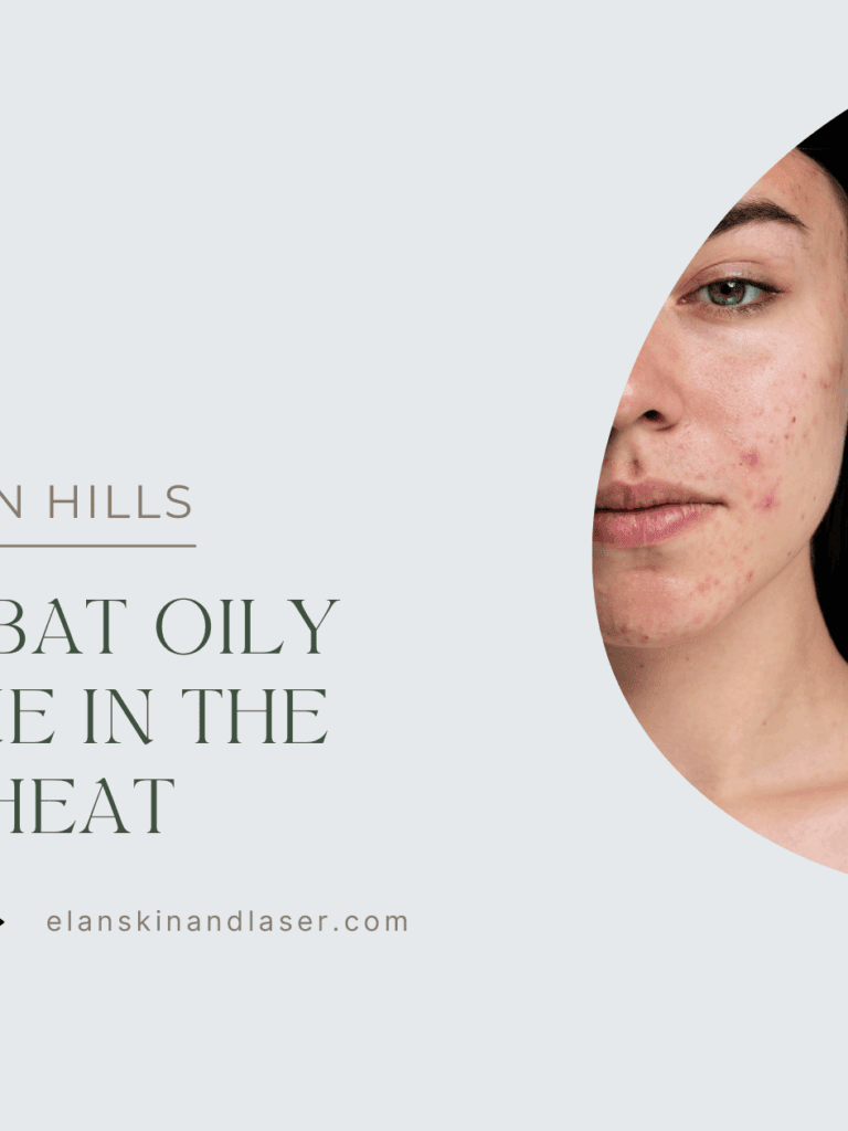 How to Combat Oily Skin and Acne in the Summer Heat