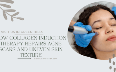 Microneedling Nashville: How Collagen Induction Therapy Repairs Acne Scars and Uneven Skin Texture